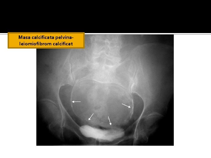 Masa calcificata pelvinaleiomiofibrom calcificat Masa calcificata pelvinaleiomiofibrom calcificat