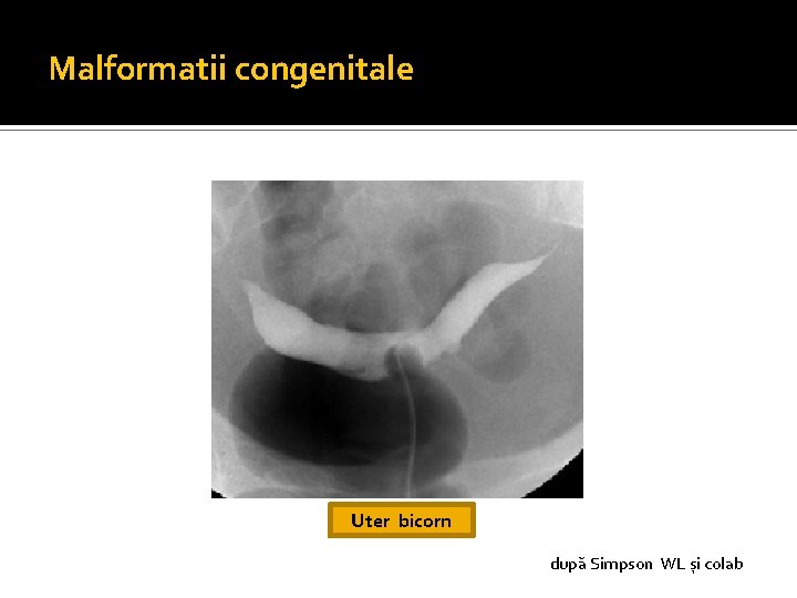 Malformatii congenitale Uter bicorn după Simpson WL și colab Malformatii congenitale Uter bicorn după Simpson WL și colab