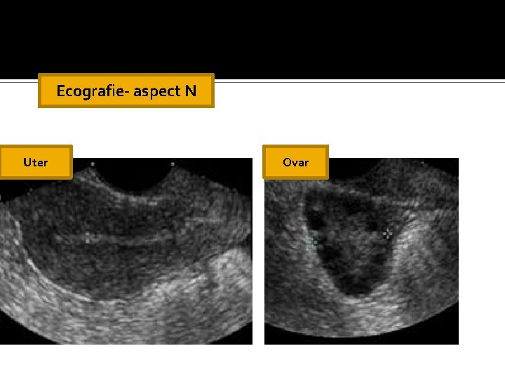 Ecografie- aspect N Uter Ovar Ecografie- aspect N Uter Ovar