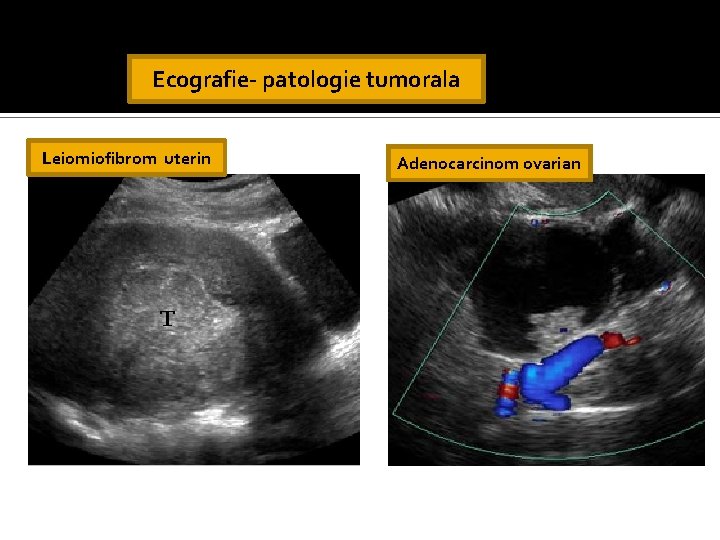 Ecografie- patologie tumorala Leiomiofibrom uterin Adenocarcinom ovarian Ecografie- patologie tumorala Leiomiofibrom uterin Adenocarcinom ovarian