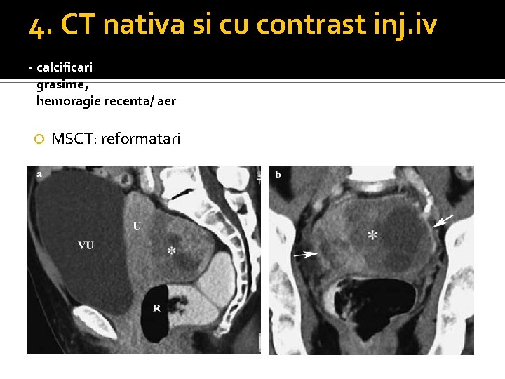 4. CT nativa si cu contrast inj. iv - calcificari - grasime, - hemoragie 4. CT nativa si cu contrast inj. iv - calcificari - grasime, - hemoragie