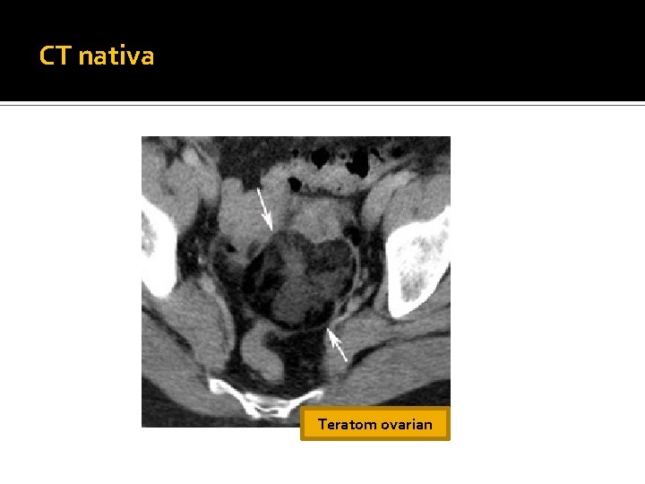 CT nativa Teratom ovarian CT nativa Teratom ovarian