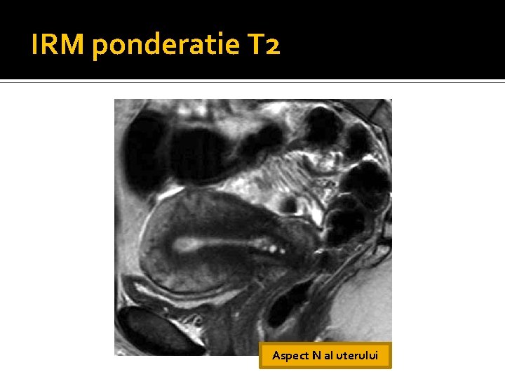 IRM ponderatie T 2 Aspect N al uterului IRM ponderatie T 2 Aspect N al uterului