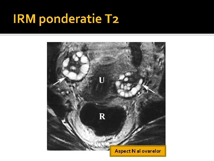 IRM ponderatie T 2 Aspect N al ovarelor IRM ponderatie T 2 Aspect N al ovarelor