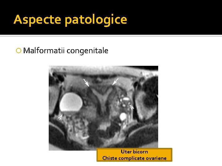 Aspecte patologice Malformatii congenitale Uter bicorn Chiste complicate ovariene Aspecte patologice Malformatii congenitale Uter bicorn Chiste complicate ovariene
