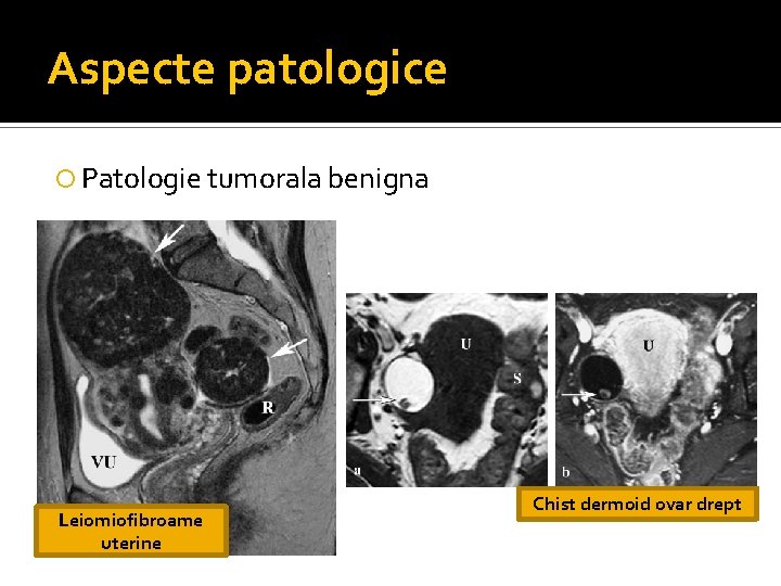 Aspecte patologice Patologie tumorala benigna Leiomiofibroame uterine Chist dermoid ovar drept Aspecte patologice Patologie tumorala benigna Leiomiofibroame uterine Chist dermoid ovar drept