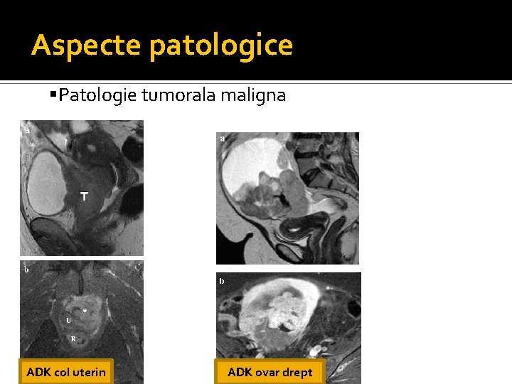Aspecte patologice Patologie tumorala maligna ADK col uterin ADK ovar drept Aspecte patologice Patologie tumorala maligna ADK col uterin ADK ovar drept
