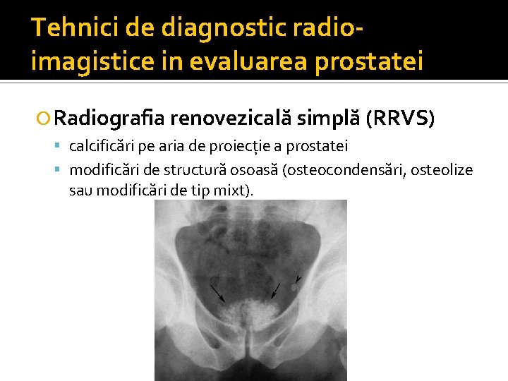Tehnici de diagnostic radioimagistice in evaluarea prostatei Radiografia renovezicală simplă (RRVS) calcificări pe aria Tehnici de diagnostic radioimagistice in evaluarea prostatei Radiografia renovezicală simplă (RRVS) calcificări pe aria