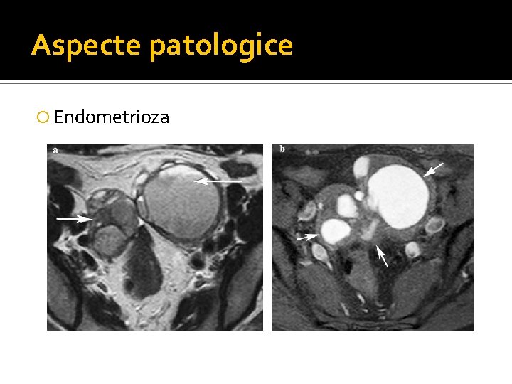 Aspecte patologice Endometrioza Aspecte patologice Endometrioza