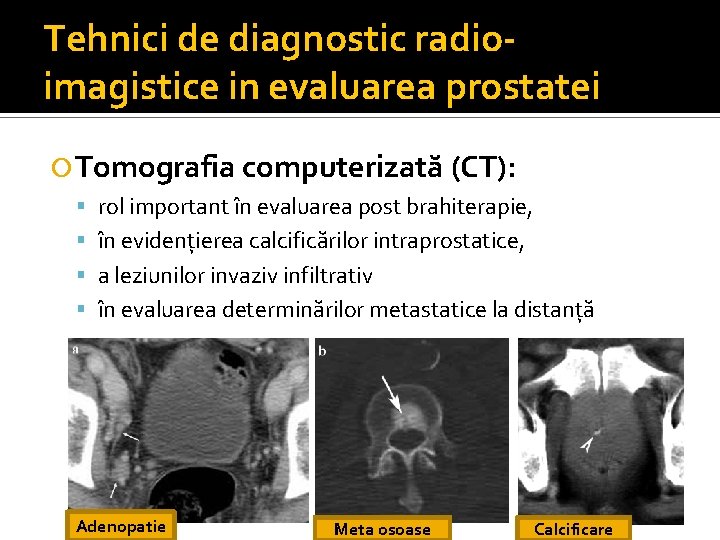 Tehnici de diagnostic radioimagistice in evaluarea prostatei Tomografia computerizată (CT): rol important în evaluarea Tehnici de diagnostic radioimagistice in evaluarea prostatei Tomografia computerizată (CT): rol important în evaluarea