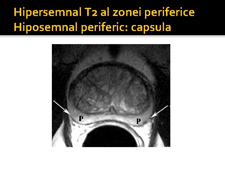 Hipersemnal T 2 al zonei periferice Hiposemnal periferic: capsula Hipersemnal T 2 al zonei periferice Hiposemnal periferic: capsula