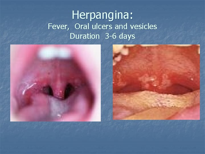 Herpangina: Fever, Oral ulcers and vesicles Duration 3 -6 days 