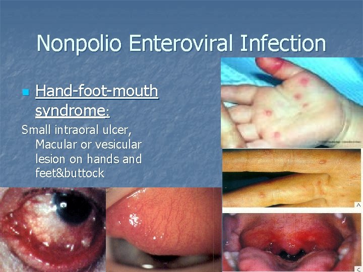 Nonpolio Enteroviral Infection n Hand-foot-mouth syndrome: Small intraoral ulcer, Macular or vesicular lesion on