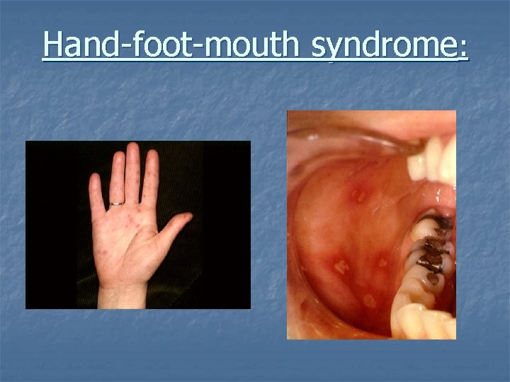 Hand-foot-mouth syndrome: 