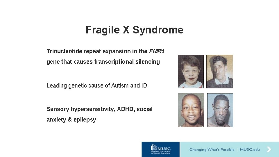 Fragile X Syndrome Trinucleotide repeat expansion in the FMR 1 gene that causes transcriptional