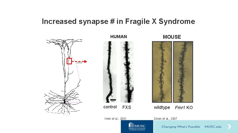 Increased synapse # in Fragile X Syndrome HUMAN control FXS Irwin et al. ,