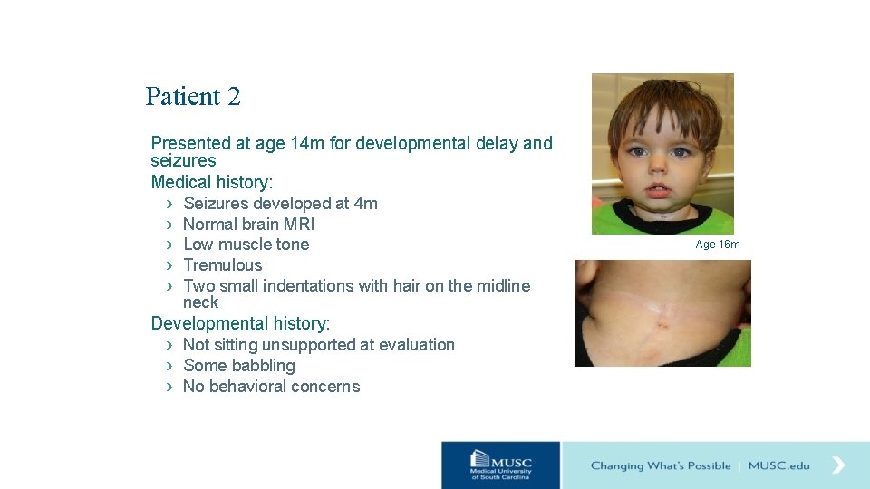 Patient 2 Presented at age 14 m for developmental delay and seizures Medical history: