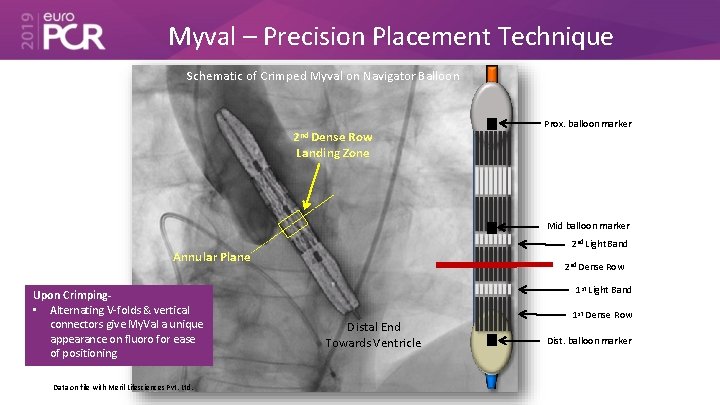 Myval – Precision Placement Technique Schematic of Crimped Myval on Navigator Balloon 2 nd