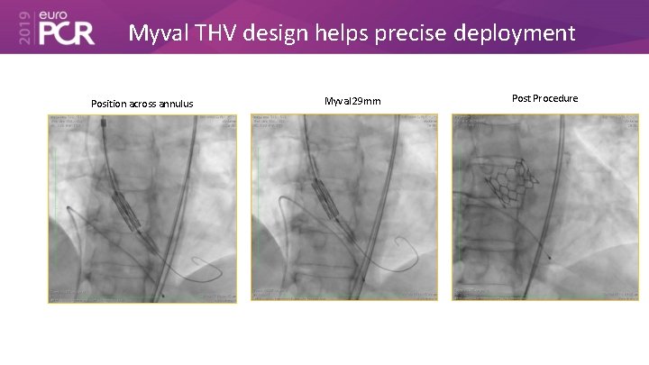 Myval THV design helps precise deployment Position across annulus Myval 29 mm Post Procedure