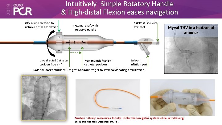 Intuitively Simple Rotatory Handle & High-distal Flexion eases navigation Clock-wise rotation to achieve distal