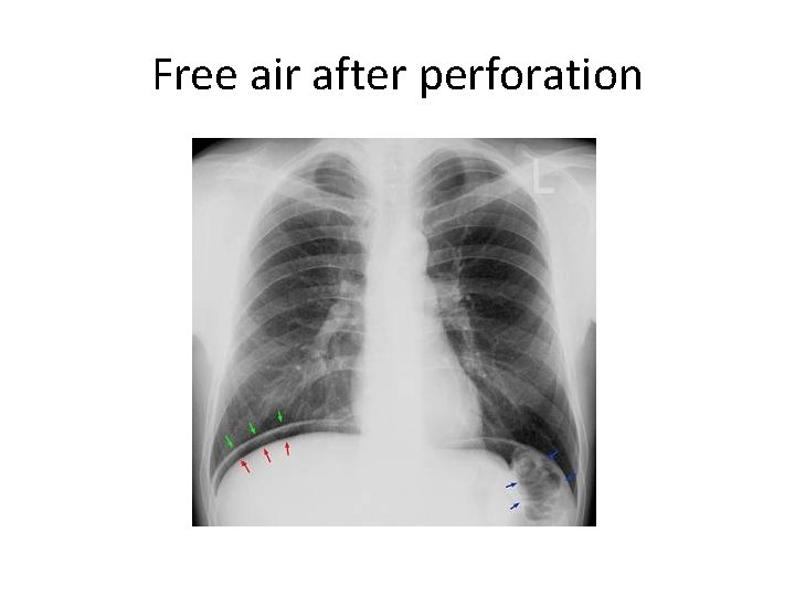 Free air after perforation 