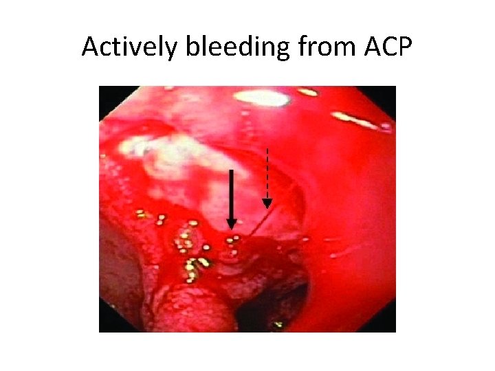 Actively bleeding from ACP 