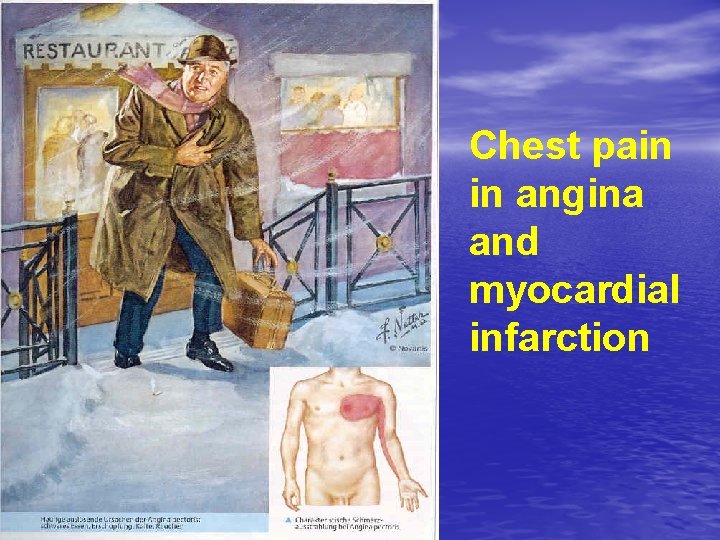 Chest pain in angina and myocardial infarction 