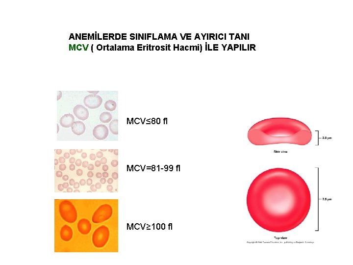 ANEMİLERDE SINIFLAMA VE AYIRICI TANI MCV ( Ortalama Eritrosit Hacmi) İLE YAPILIR MCV≤ 80