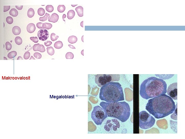 Makroovalosit Megaloblast 