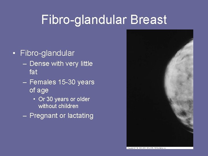 Fibro-glandular Breast • Fibro-glandular – Dense with very little fat – Females 15 -30