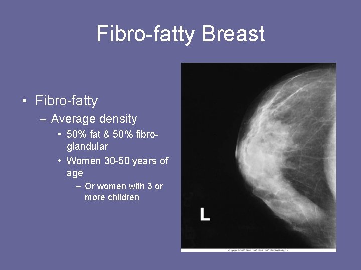 Fibro-fatty Breast • Fibro-fatty – Average density • 50% fat & 50% fibroglandular •