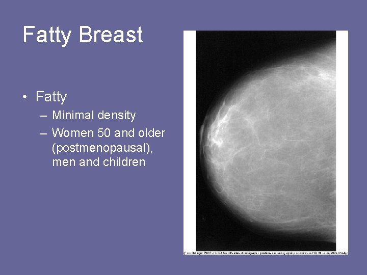 Fatty Breast • Fatty – Minimal density – Women 50 and older (postmenopausal), men