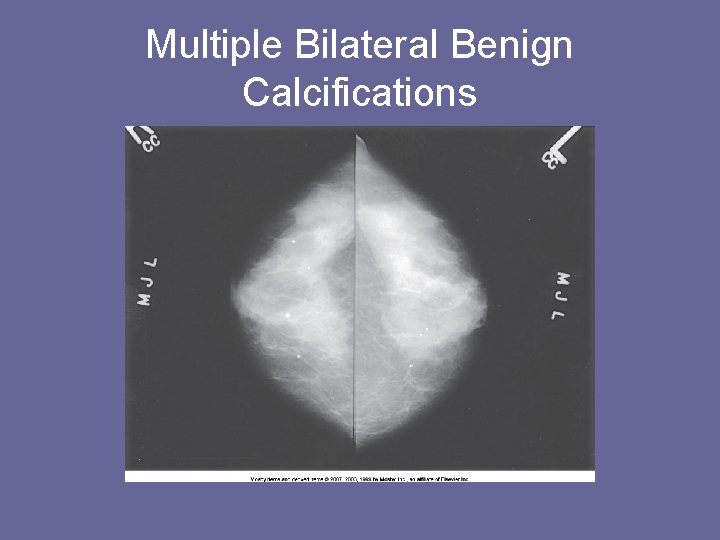 Multiple Bilateral Benign Calcifications 