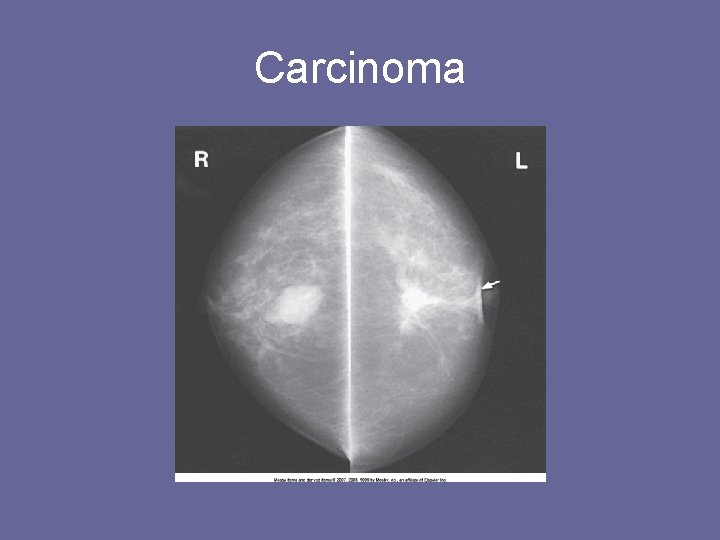 Carcinoma 