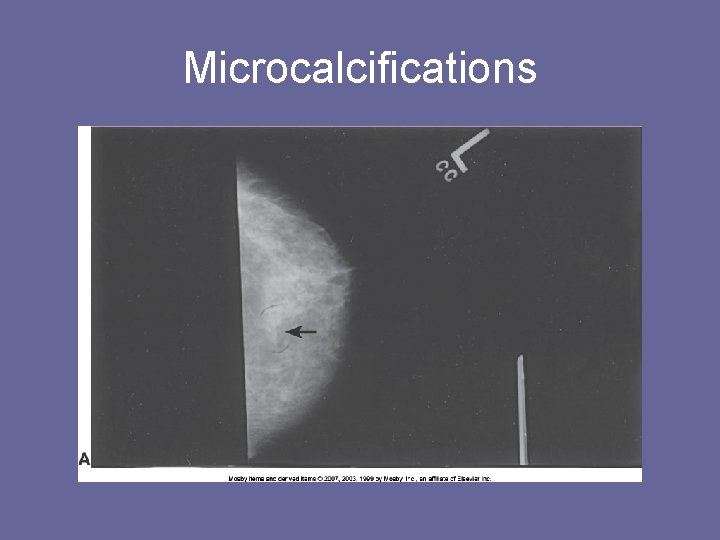 Microcalcifications 