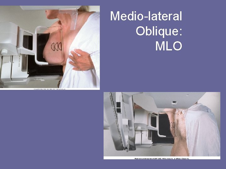 Medio-lateral Oblique: MLO 