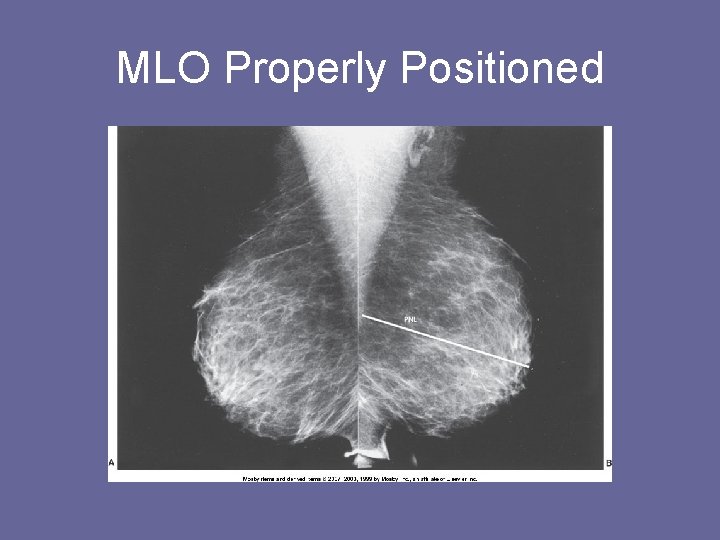 MLO Properly Positioned 