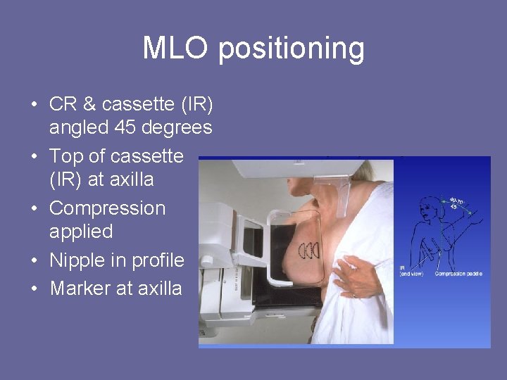 MLO positioning • CR & cassette (IR) angled 45 degrees • Top of cassette