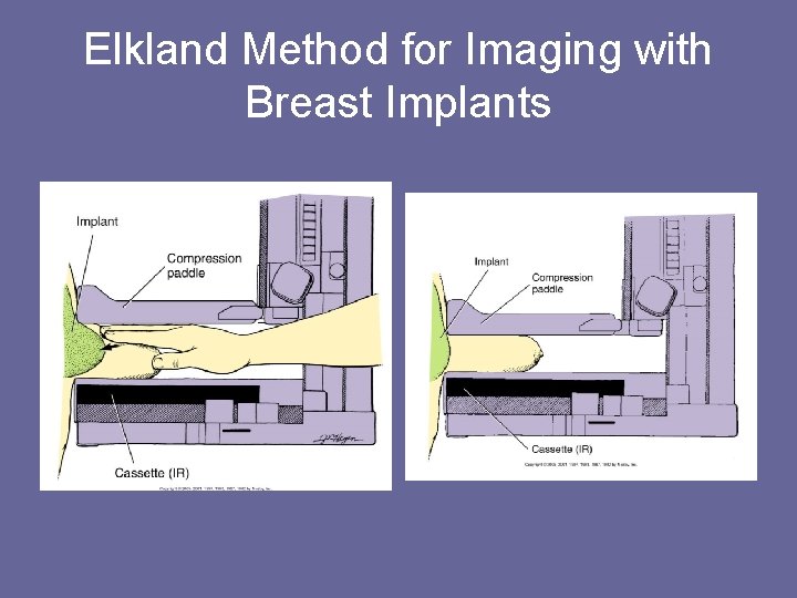 Elkland Method for Imaging with Breast Implants 