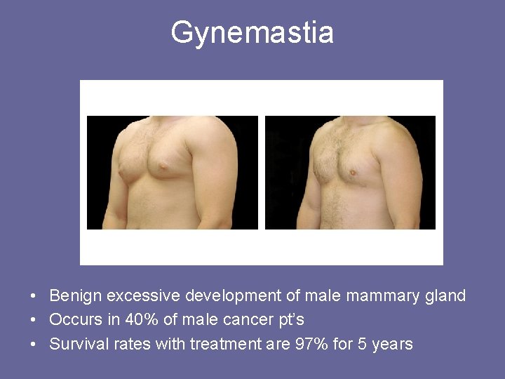 Gynemastia • Benign excessive development of male mammary gland • Occurs in 40% of