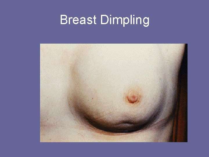 Breast Dimpling 