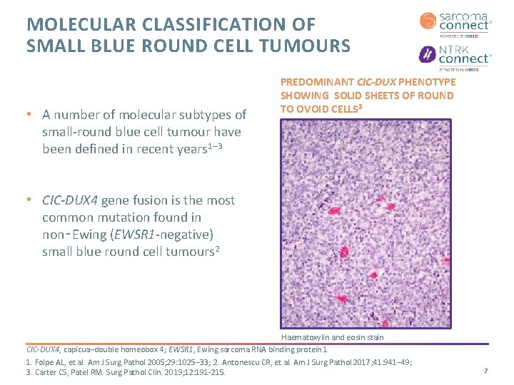 MOLECULAR CLASSIFICATION OF SMALL BLUE ROUND CELL TUMOURS • A number of molecular subtypes