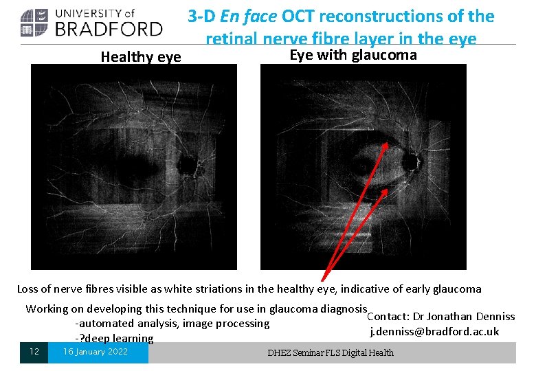 Healthy eye 3 -D En face OCT reconstructions of the retinal nerve fibre layer Healthy eye 3 -D En face OCT reconstructions of the retinal nerve fibre layer