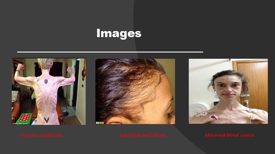 Images Extreme weight loss Hair Break and fall out Abnormal blood counts 