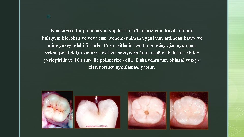 z Konservatif bir preparasyon yapılarak çürük temizlenir, kavite derinse kalsiyum hidroksit ve/veya cam iyonomer