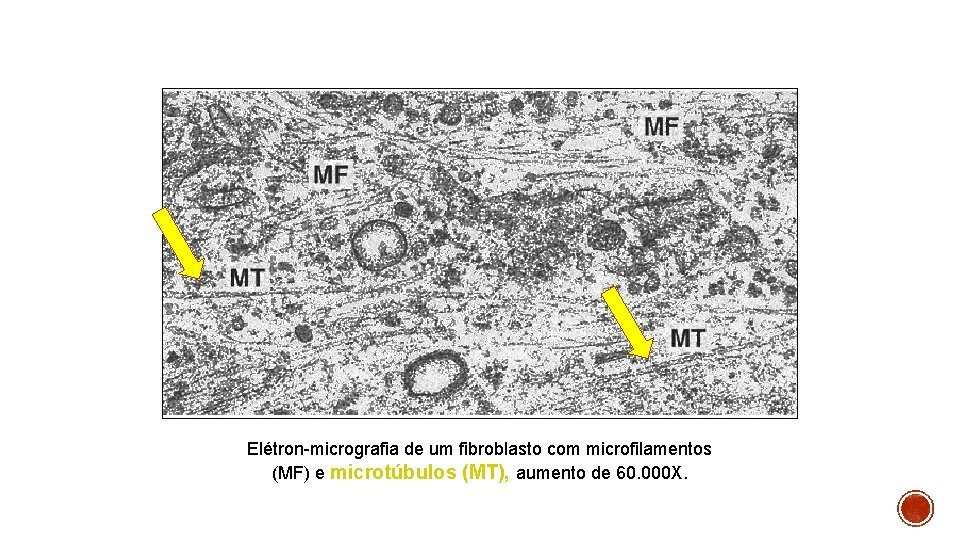 Elétron-micrografia de um fibroblasto com microfilamentos (MF) e microtúbulos (MT), aumento de 60. 000