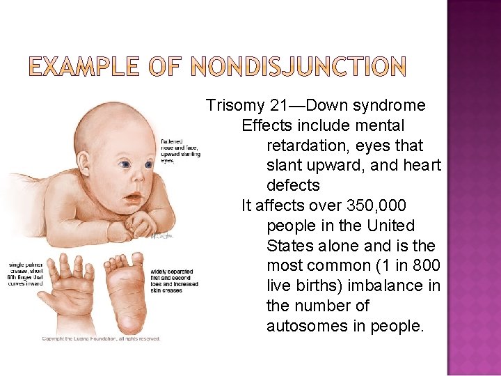 Trisomy 21—Down syndrome Effects include mental retardation, eyes that slant upward, and heart defects