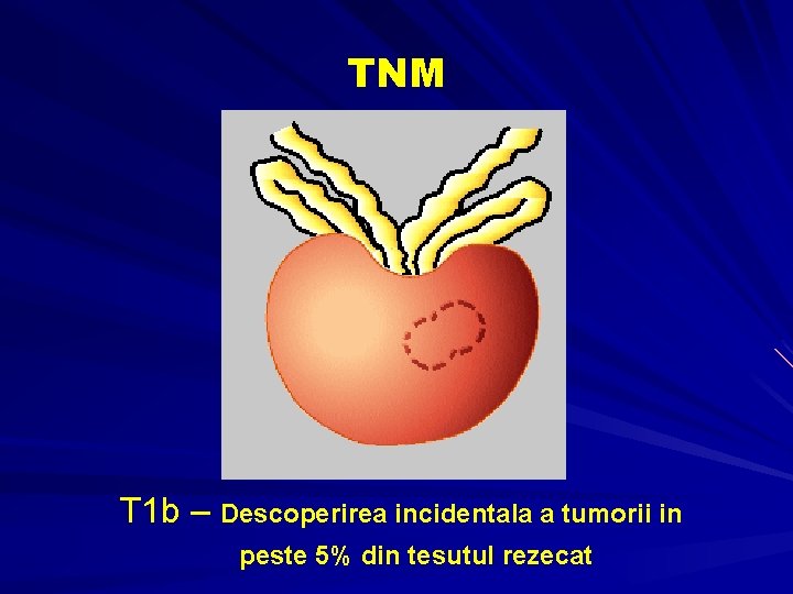 TNM T 1 b – Descoperirea incidentala a tumorii in peste 5% din tesutul TNM T 1 b – Descoperirea incidentala a tumorii in peste 5% din tesutul