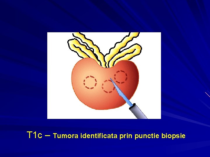 T 1 c – Tumora identificata prin punctie biopsie T 1 c – Tumora identificata prin punctie biopsie