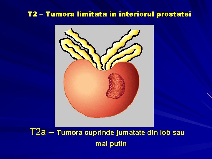 T 2 – Tumora limitata in interiorul prostatei T 2 a – Tumora cuprinde T 2 – Tumora limitata in interiorul prostatei T 2 a – Tumora cuprinde